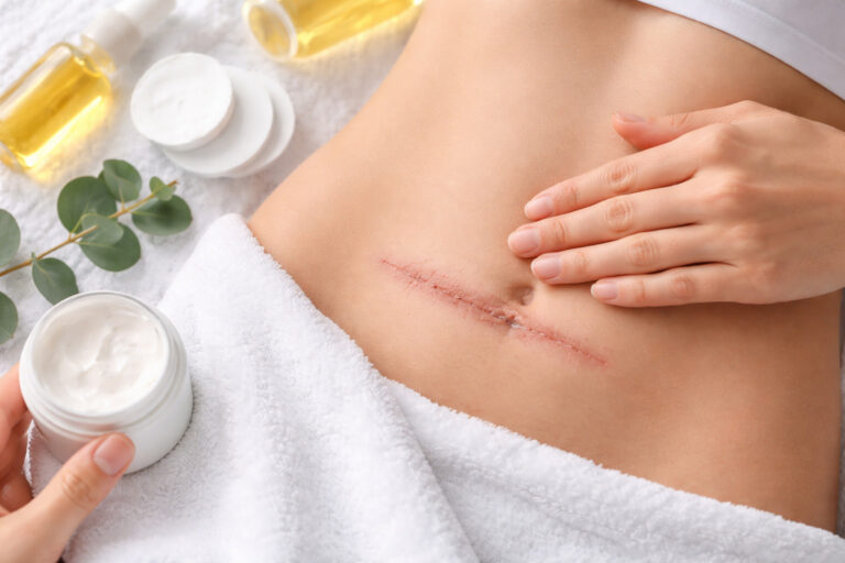 Blizna po opuszczeniu szpitala – jak o nią zadbać?