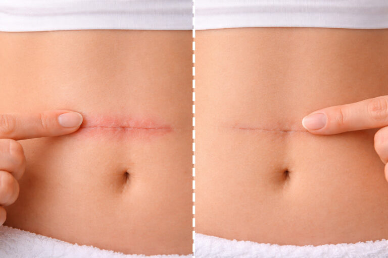 Jak odróżnić bliznę aktywną od dojrzałej i dlaczego ma to znaczenie?