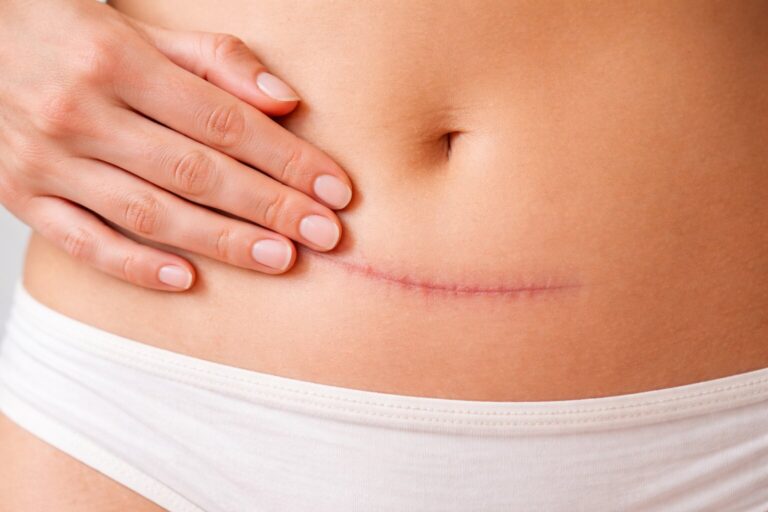 Jak przyspieszyć gojenie blizny po zabiegu?
